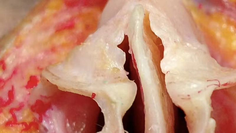 Nose Treatments: Nasal Tip Support with Needle