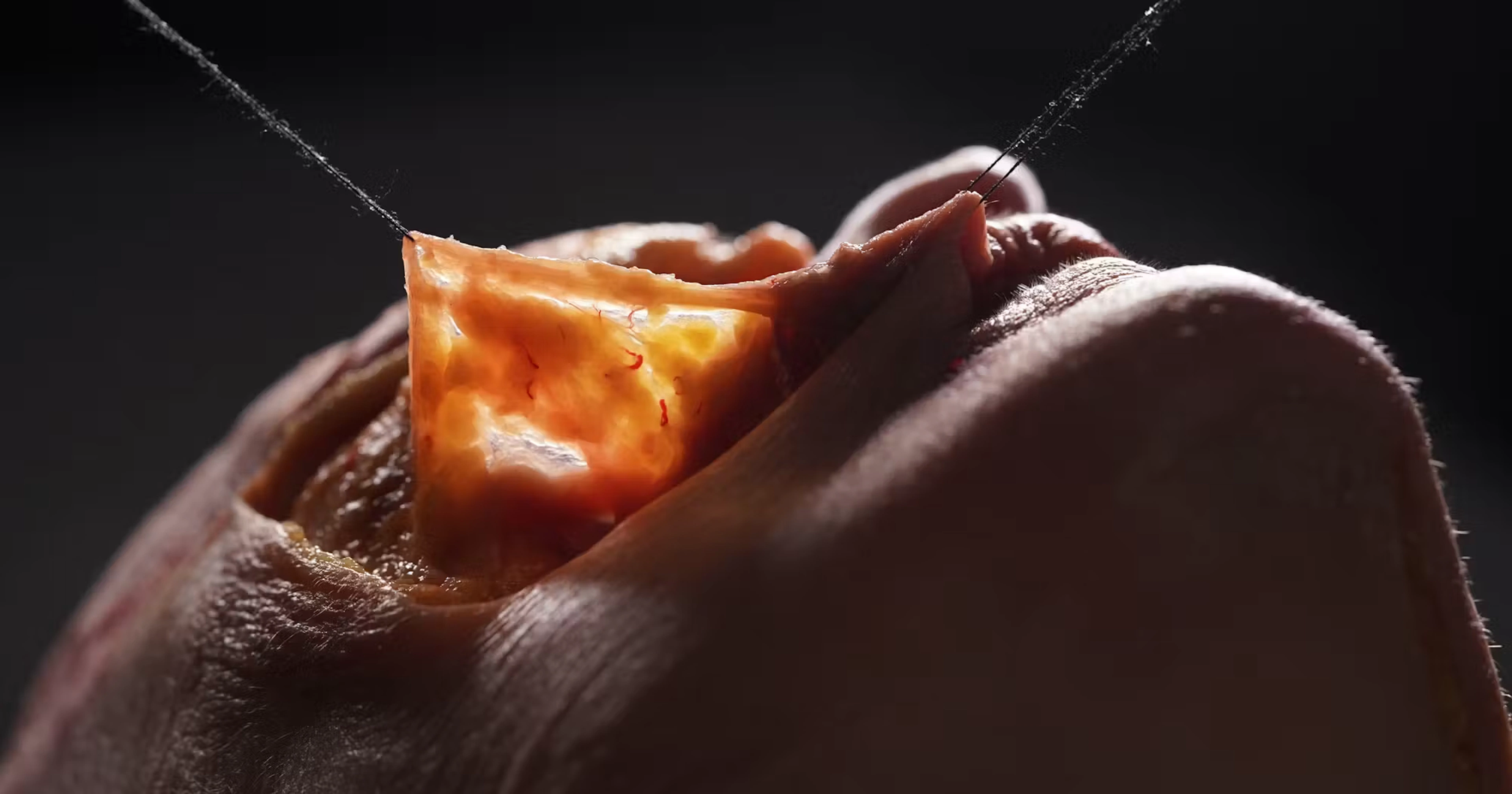 Photographic image of the Transverse Facial Septum