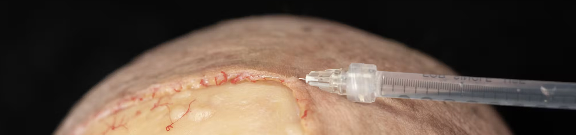 Treating Frontal Rhytids with Fillers: Intradermal Needle Technique