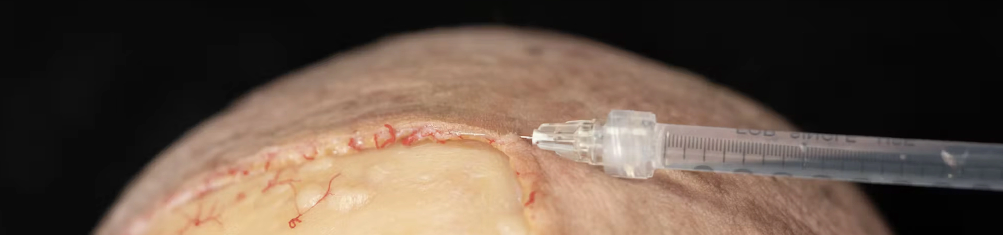 Treating Frontal Rhytids with Fillers: Intradermal Needle Technique