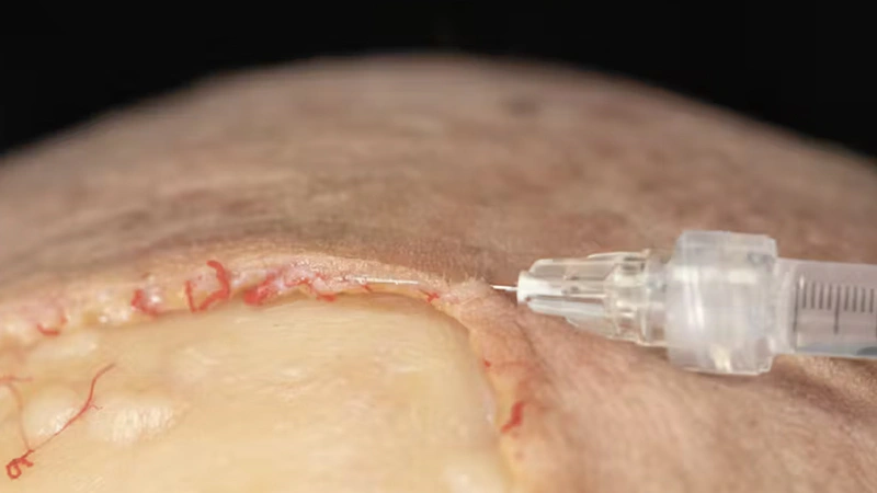 Treating Frontal Rhytids with Fillers: Intradermal Needle Technique