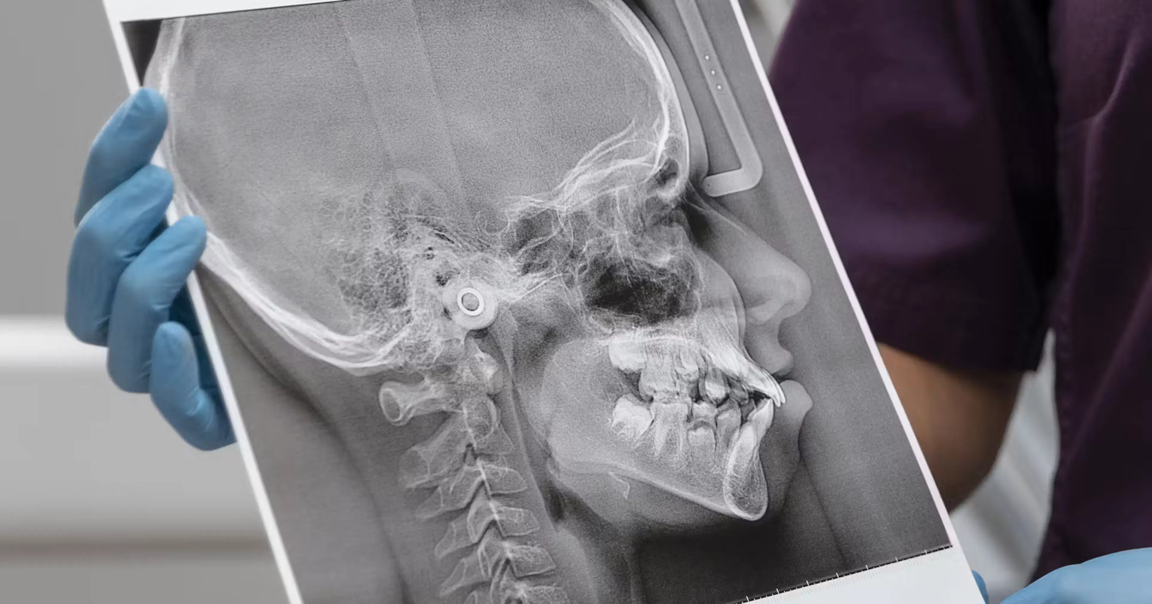 ultrasound imaging to identify the line of convergence