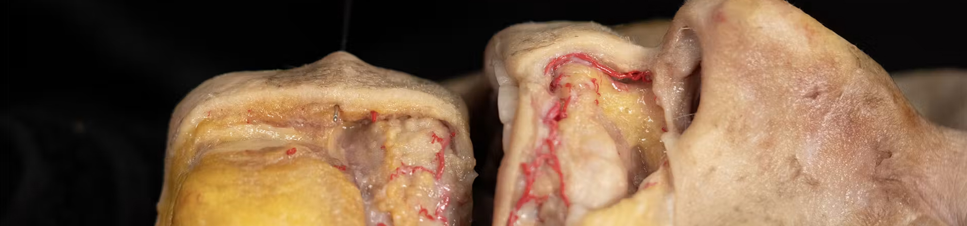 Labiomental Sulcus Smoothening (Needle and Cannula Techniques)