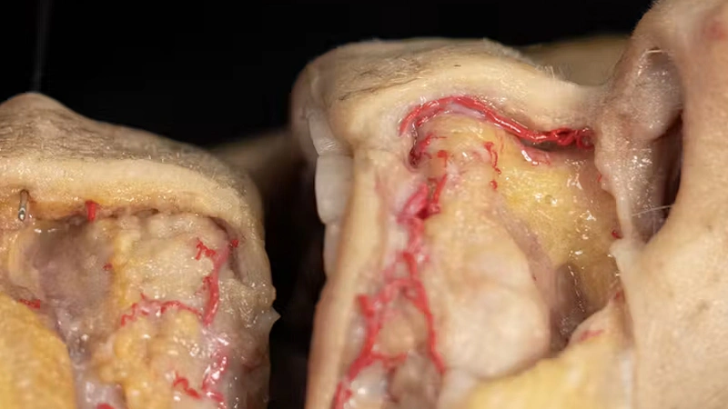 Labiomental Sulcus Smoothening (Needle and Cannula Techniques)