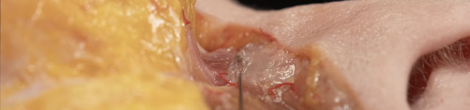 Tear Trough Treatment with Needle and Cannula