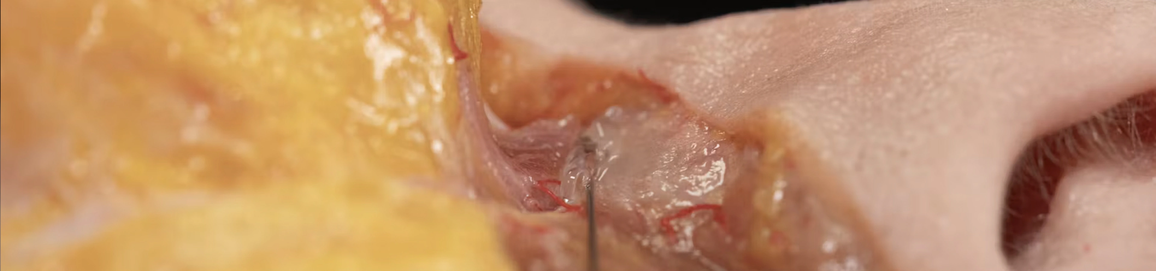 Tear Trough Treatment with Needle and Cannula