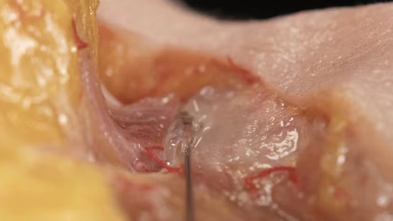 Tear Trough Treatment with Needle and Cannula