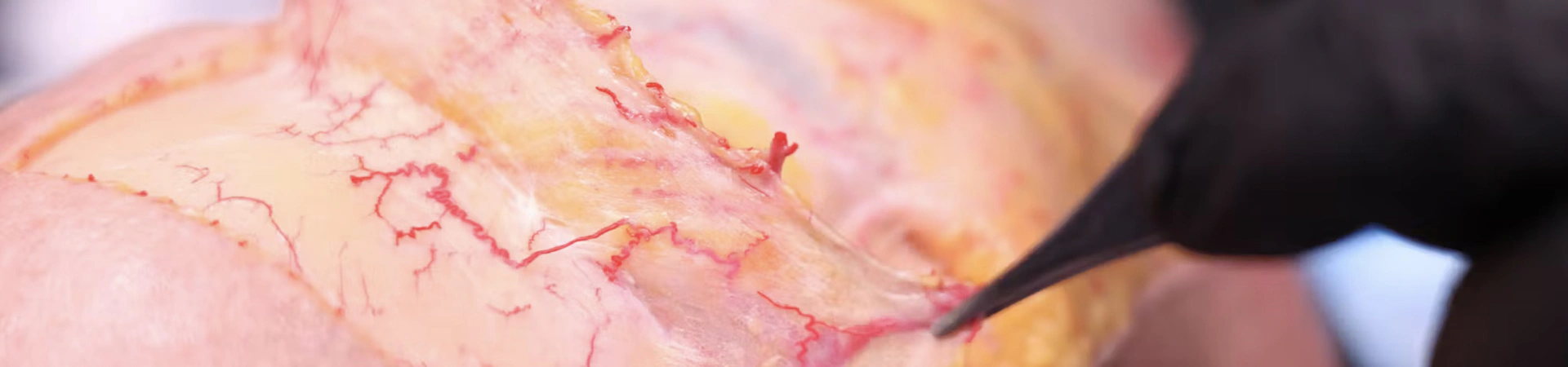 Basic Anatomy for Neuromodulator Treatments: Frontalis Muscle