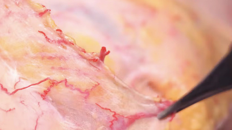 Basic Anatomy for Neuromodulator Treatments: Frontalis Muscle