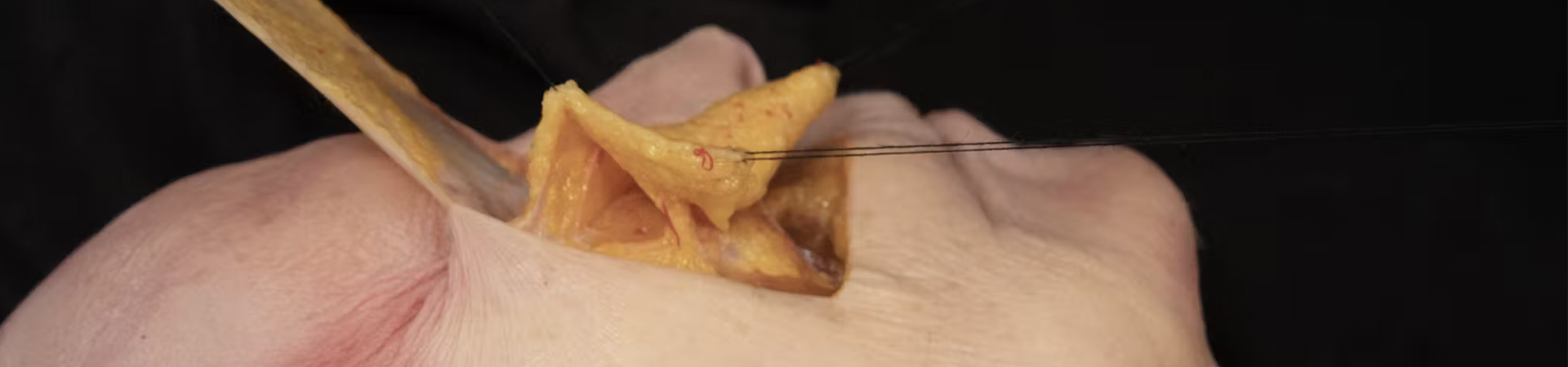 Tear Trough Treatments: Deep Cannula Technique (Lateral Approach)