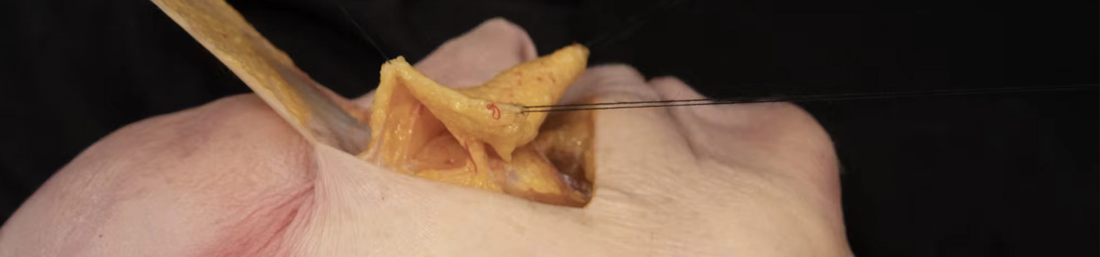 Tear Trough Treatments: Deep Cannula Technique (Lateral Approach)