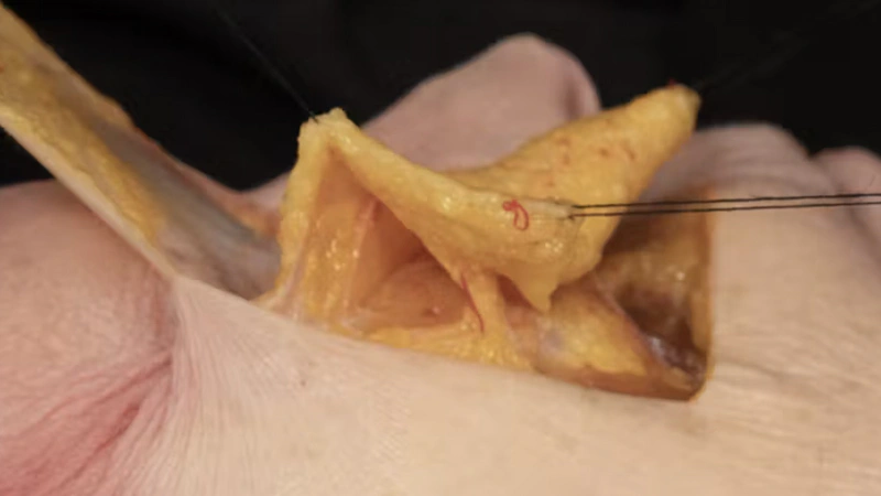 Tear Trough Treatments: Deep Cannula Technique (Lateral Approach)