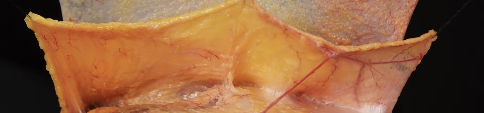Facial Ligaments