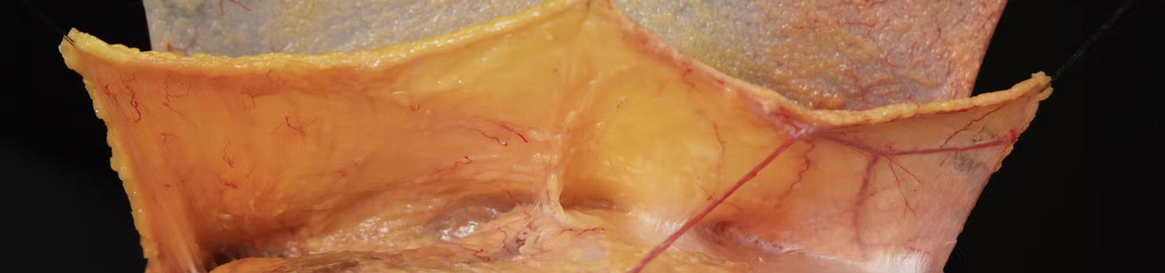 Facial Ligaments
