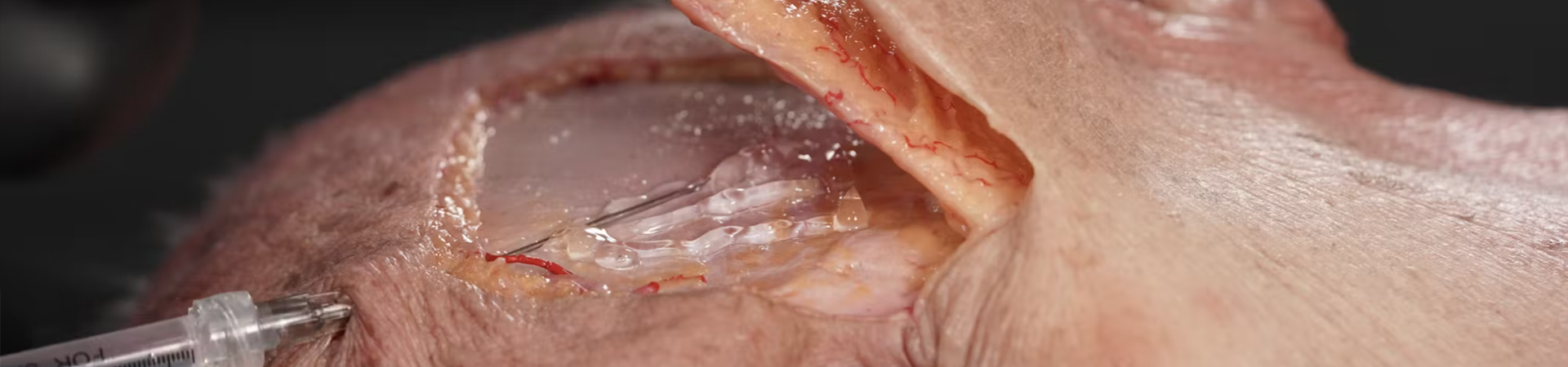 Temporal Volumization: Interfascial Technique
