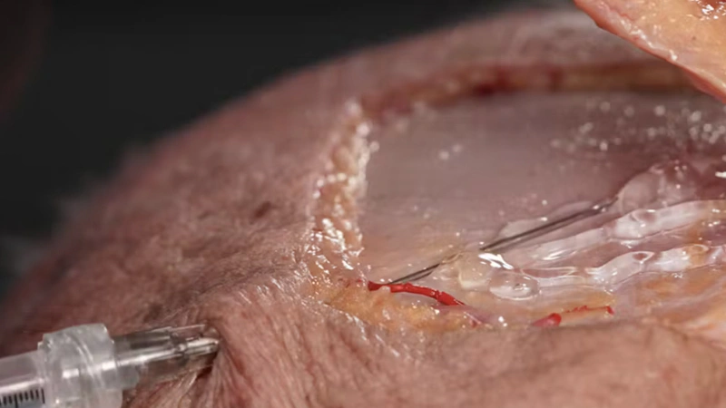 Temporal Volumization: Interfascial Technique