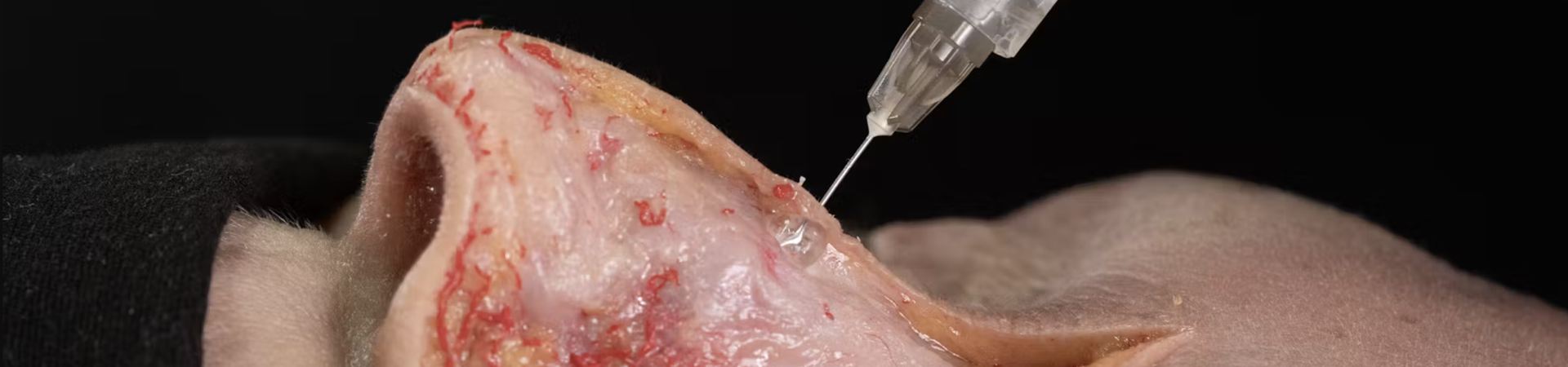 Nose Treatments: Lateral Nasal Wall Stabilization