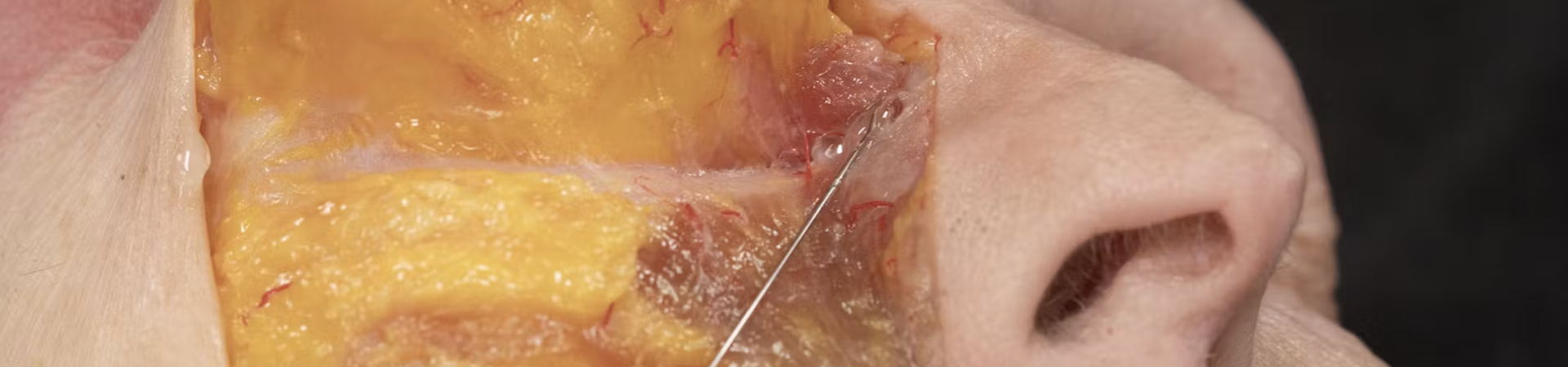 Anterior Midface Volumization: Superficial Cannula Technique
