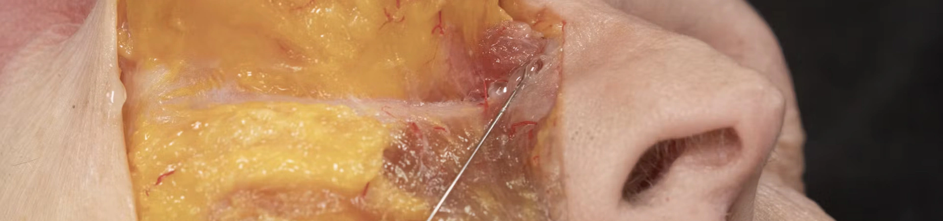 Anterior Midface Volumization: Superficial Cannula Technique