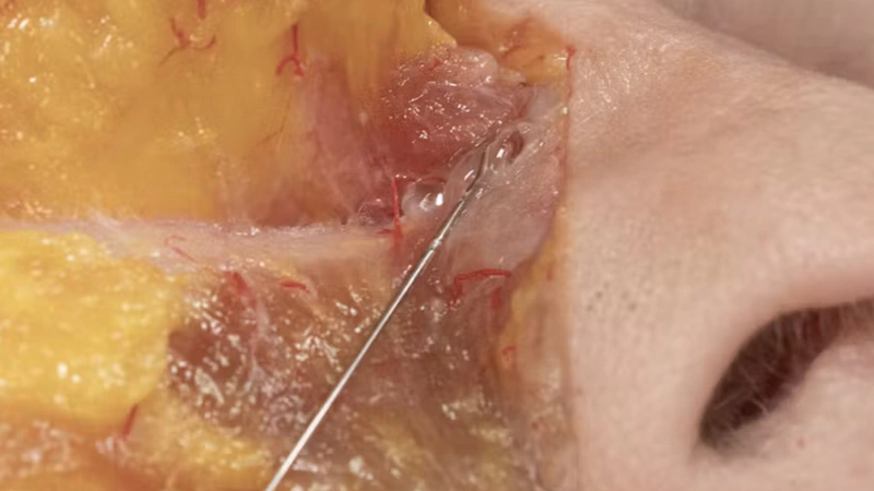 Anterior Midface Volumization: Superficial Cannula Technique