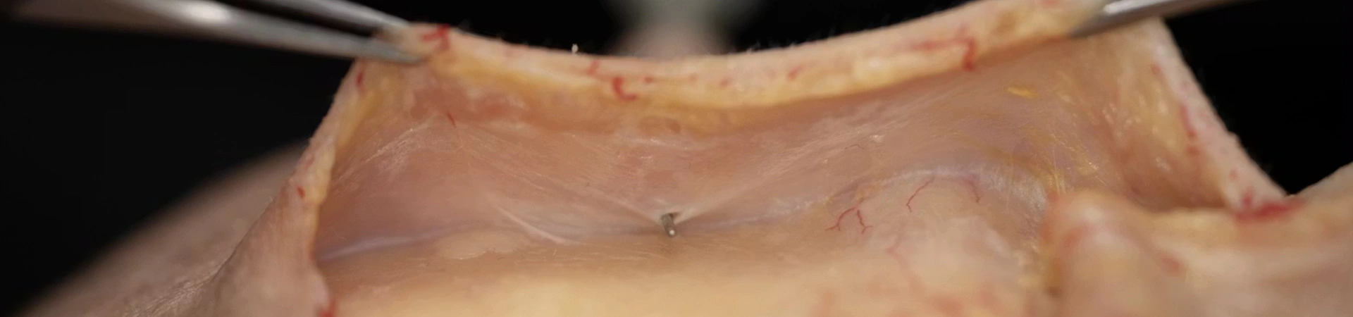 Anterior Midface Volumization: Intermediate Cannula Technique