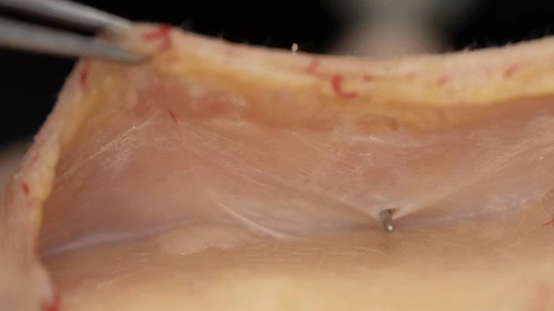 Anterior Midface Volumization: Intermediate Cannula Technique