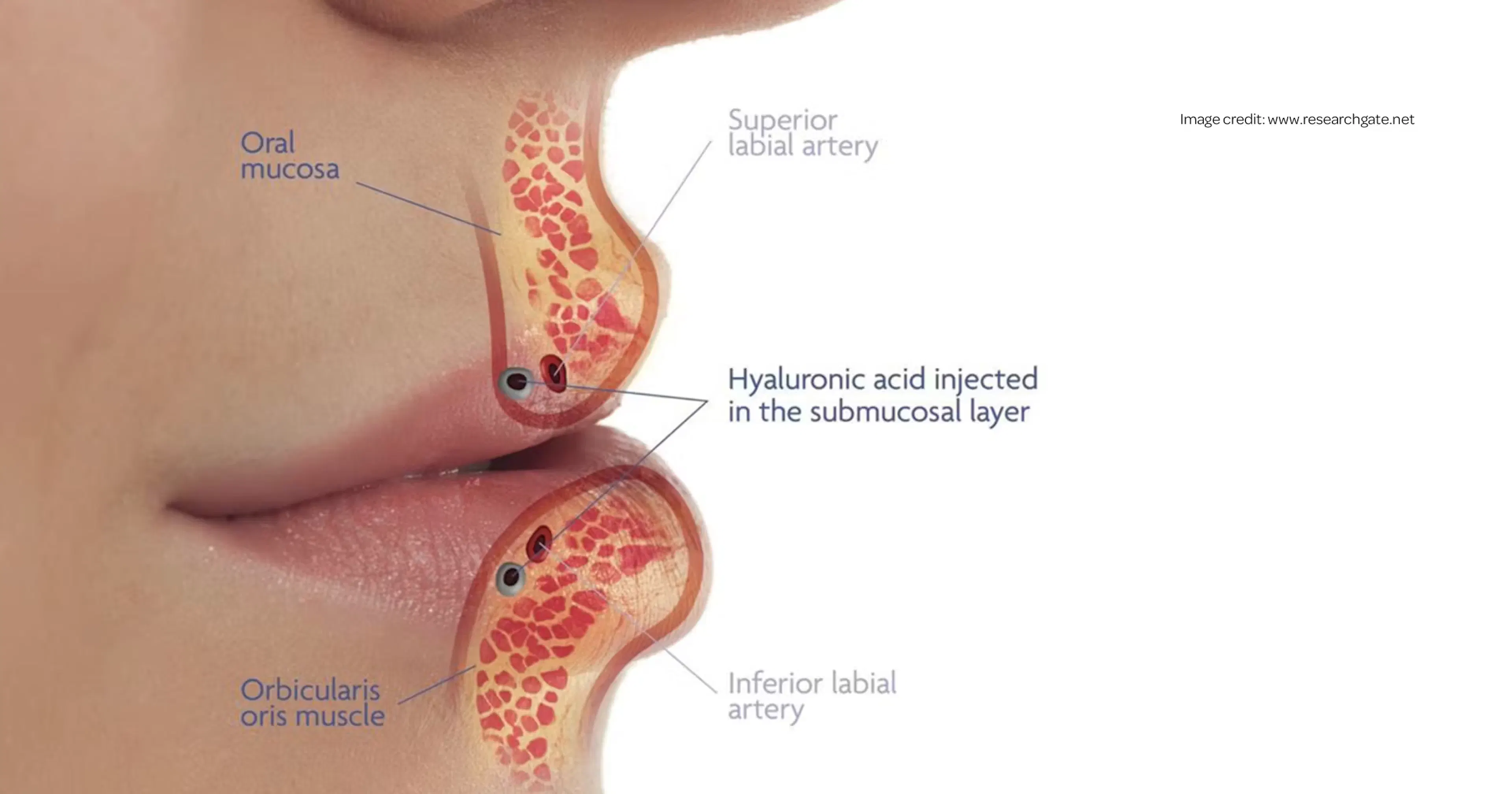 Intralabial Lip Compartments diagram
