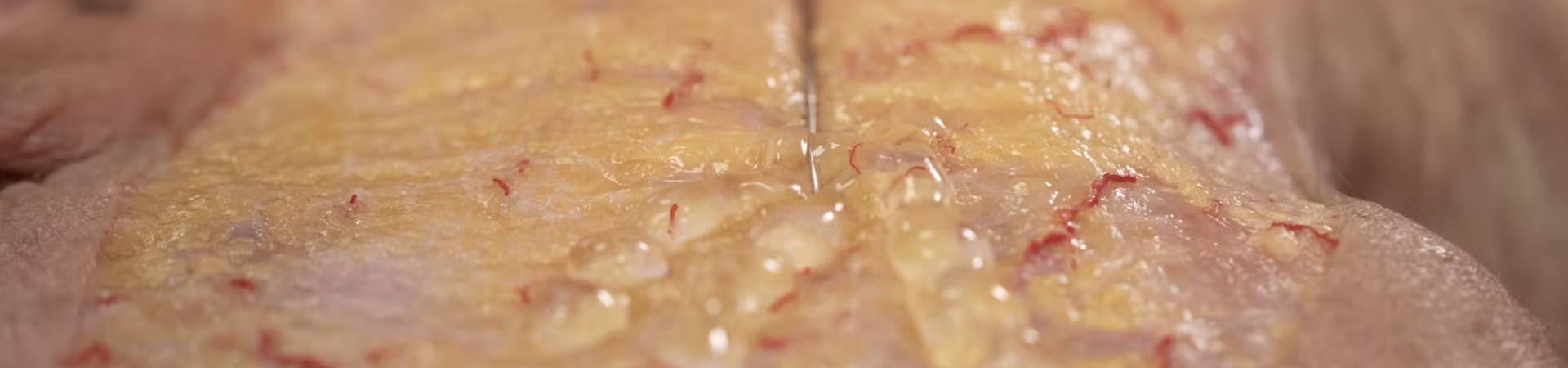 Temporal Volumization: Subdermal Cannula Technique
