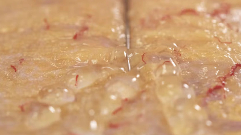 Temporal Volumization: Subdermal Cannula Technique