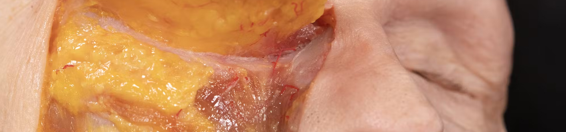Soft Tissue - Review: Middle Face