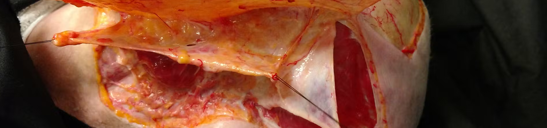 Marionette Line Treatment with Needle