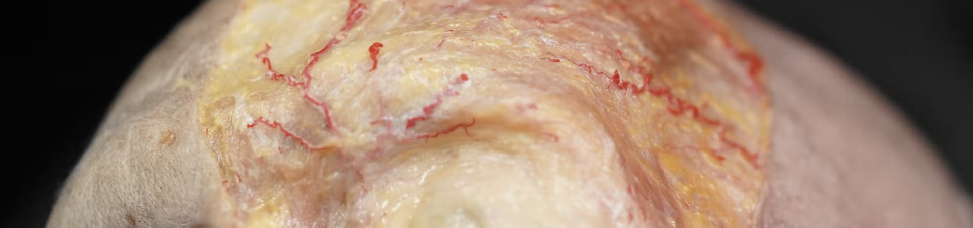 Treating Glabellar Lines with Fillers: Subdermal Cannula Technique