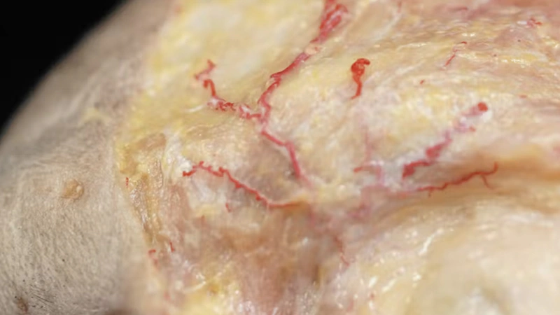 Treating Glabellar Lines with Fillers: Subdermal Cannula Technique