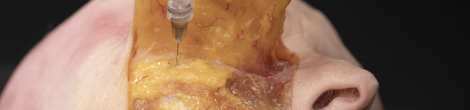 Periorbital Treatments: Palpebromalar grooves with Needle