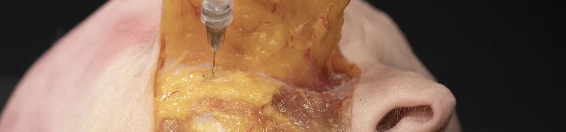 Periorbital Treatments: Palpebromalar grooves with Needle