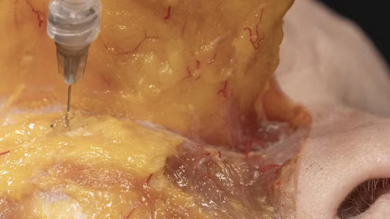 Periorbital Treatments: Palpebromalar grooves with Needle