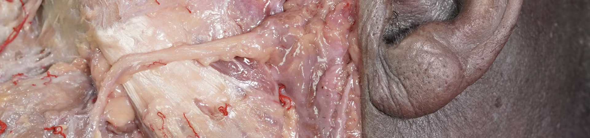 Muscles of Mastication