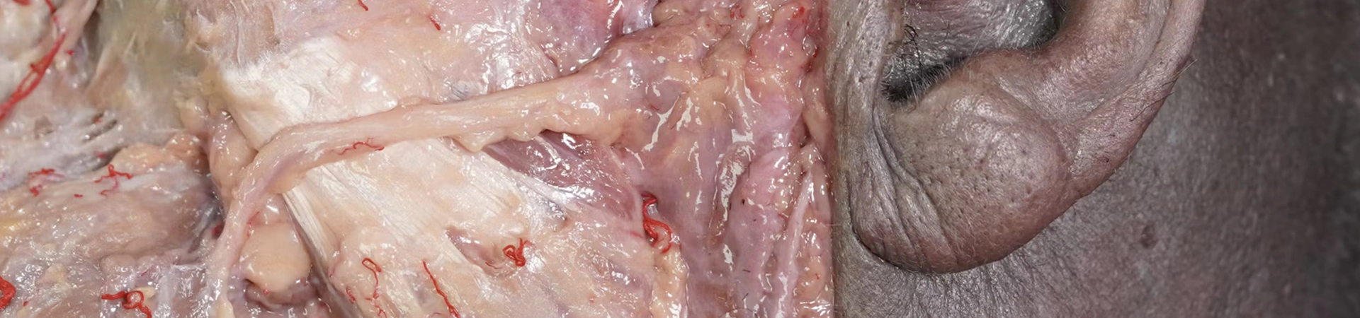 Muscles of Mastication