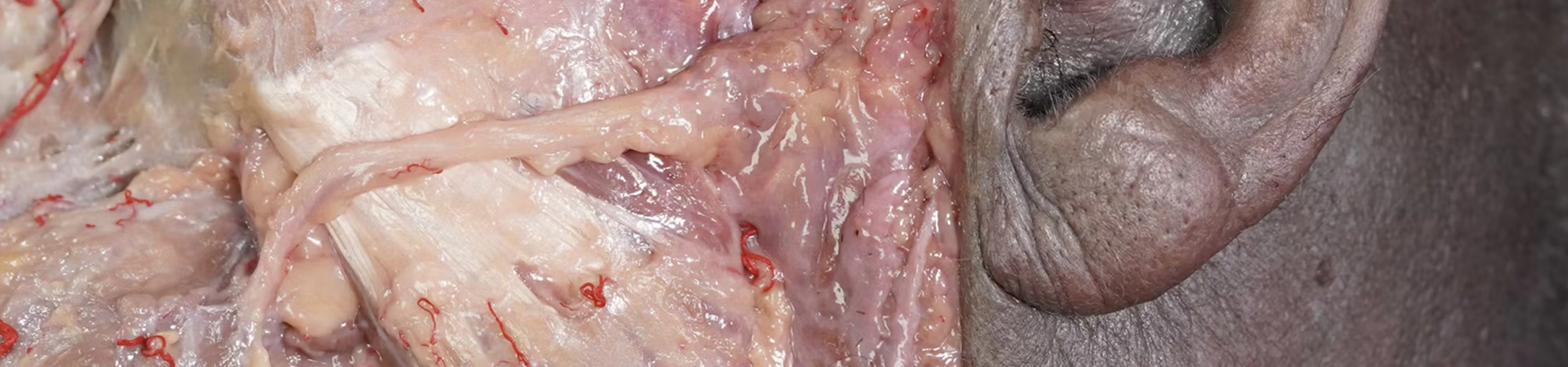 Muscles of Mastication