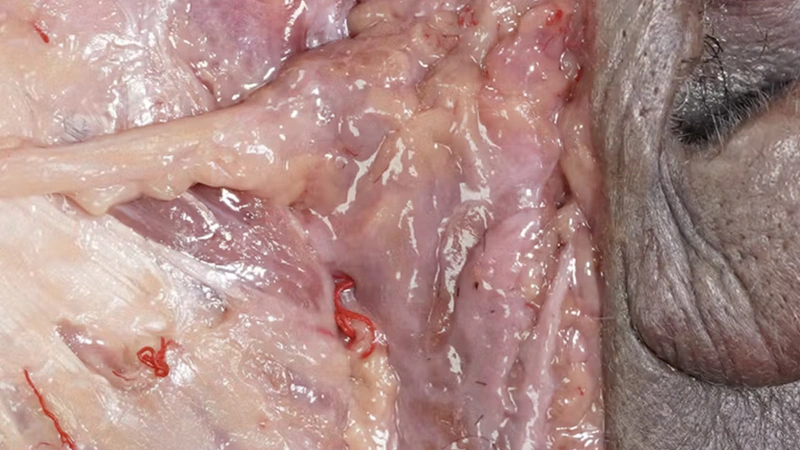 Muscles of Mastication