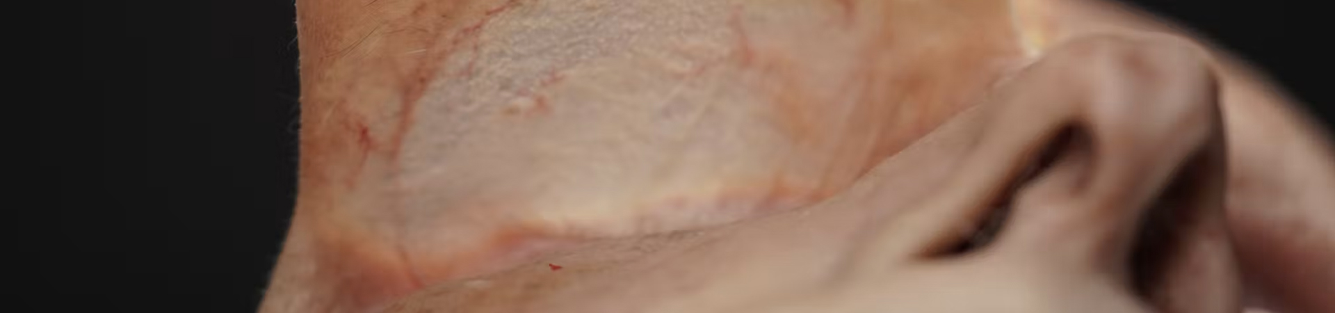 Tear Trough Treatments: Deep Needle Technique (Inferior Approach)
