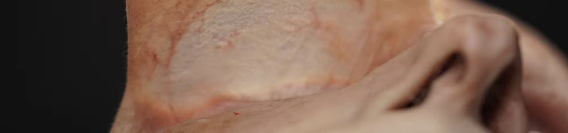 Tear Trough Treatments: Deep Needle Technique (Inferior Approach)