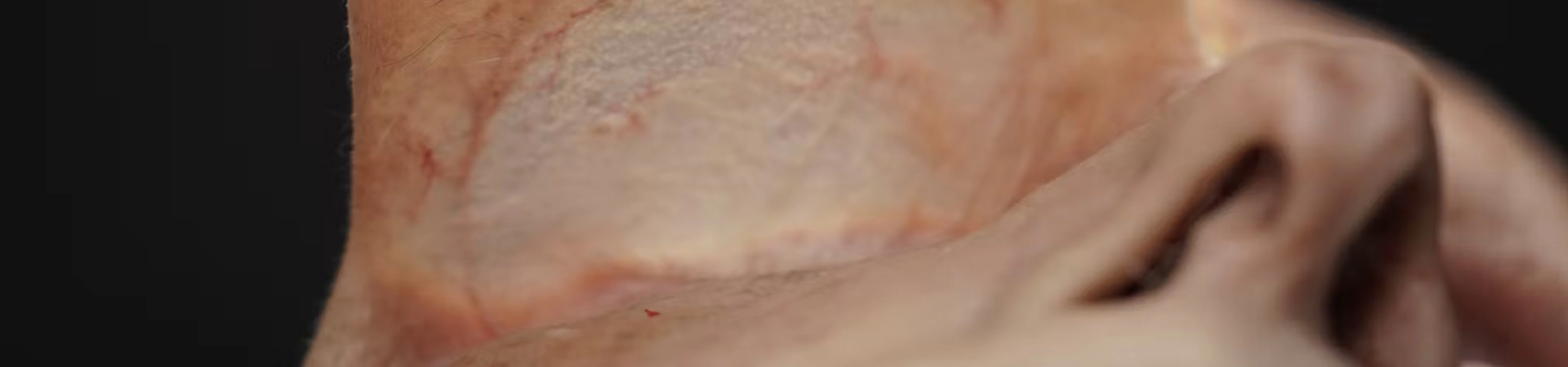 Tear Trough Treatments: Deep Needle Technique (Inferior Approach)