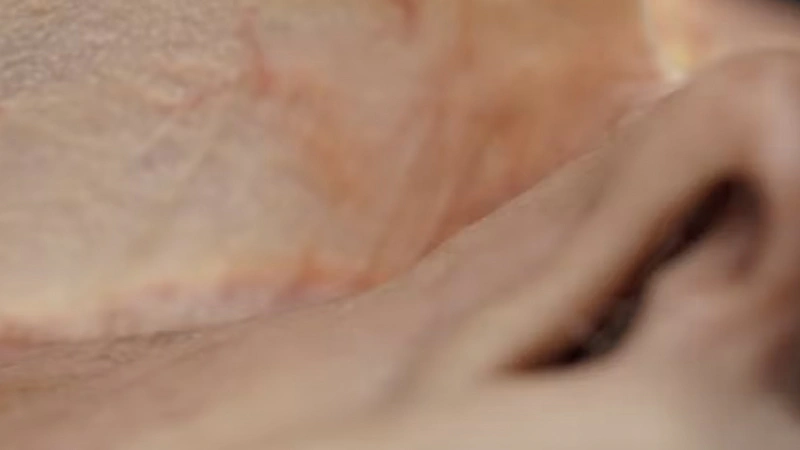 Tear Trough Treatments: Deep Needle Technique (Inferior Approach)