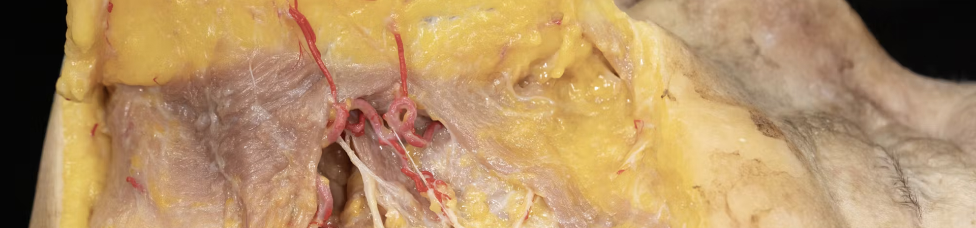Basic Anatomy for Neuromodulator Treatments: Orbicularis Oris Muscle