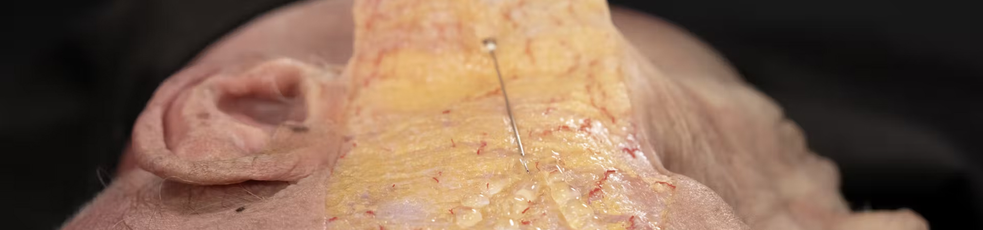 Biostimulator Treatments of the Temple: Superficial Cannula Technique