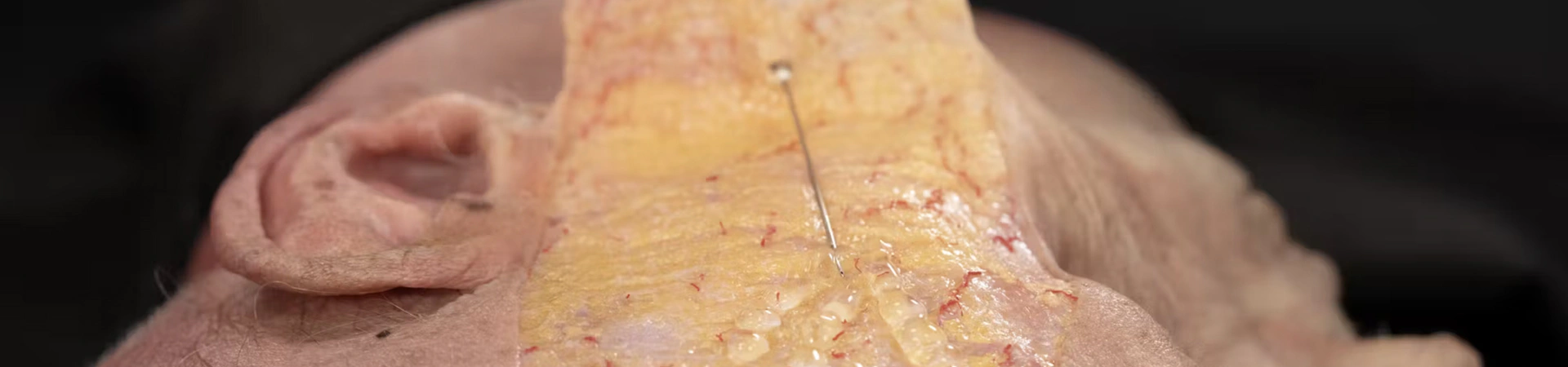 Biostimulator Treatments of the Temple: Superficial Cannula Technique