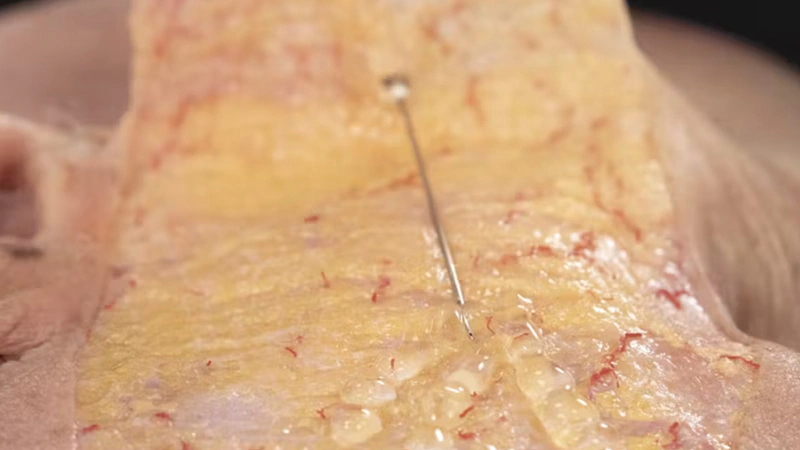 Biostimulator Treatments of the Temple: Superficial Cannula Technique