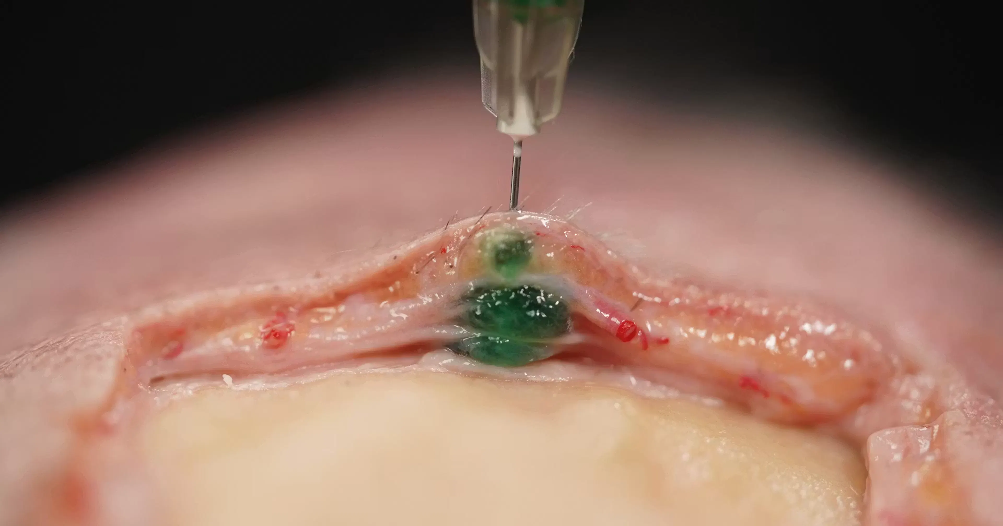 Image of soft tissue filler product migrating beyond intended planes of the skin