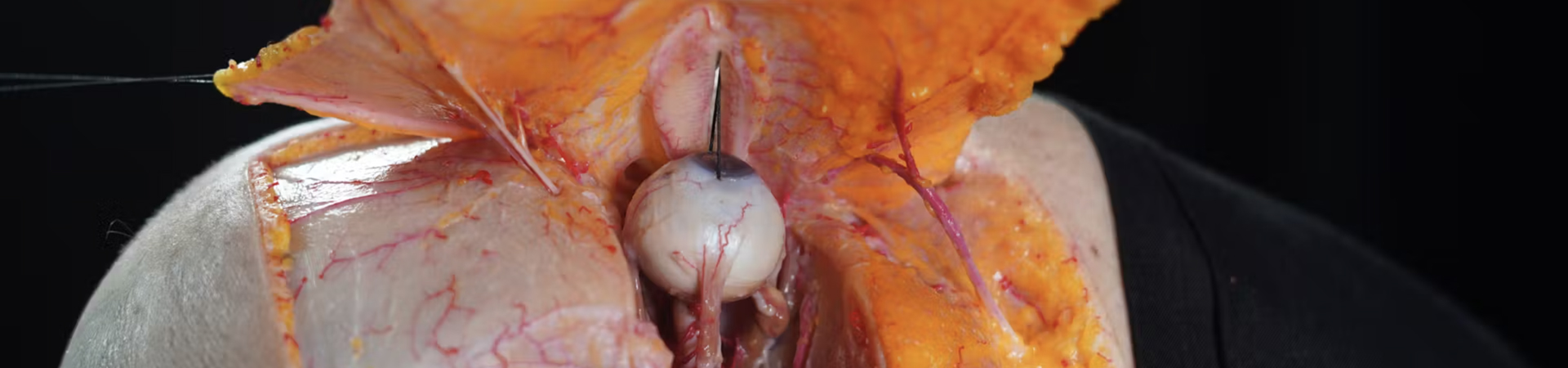 Periorbital Treatments: Palpebromalar grooves with Cannula (Inferior Approach)